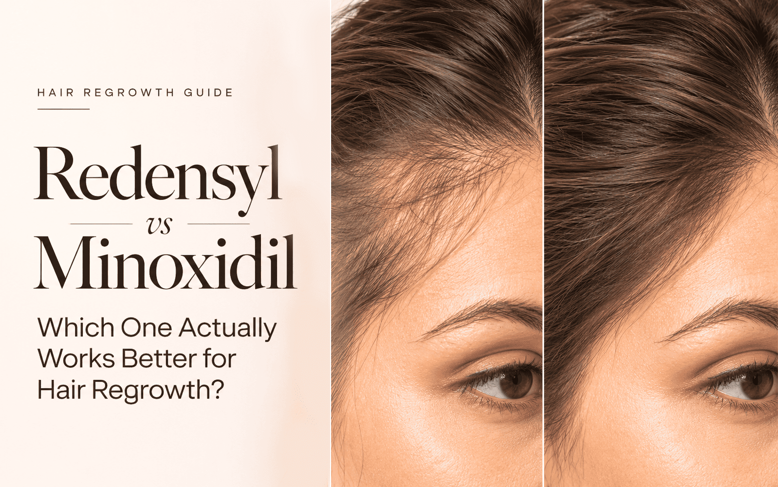 Redensyl vs Minoxidil: Which One Actually Works Better for Hair Regrowth?